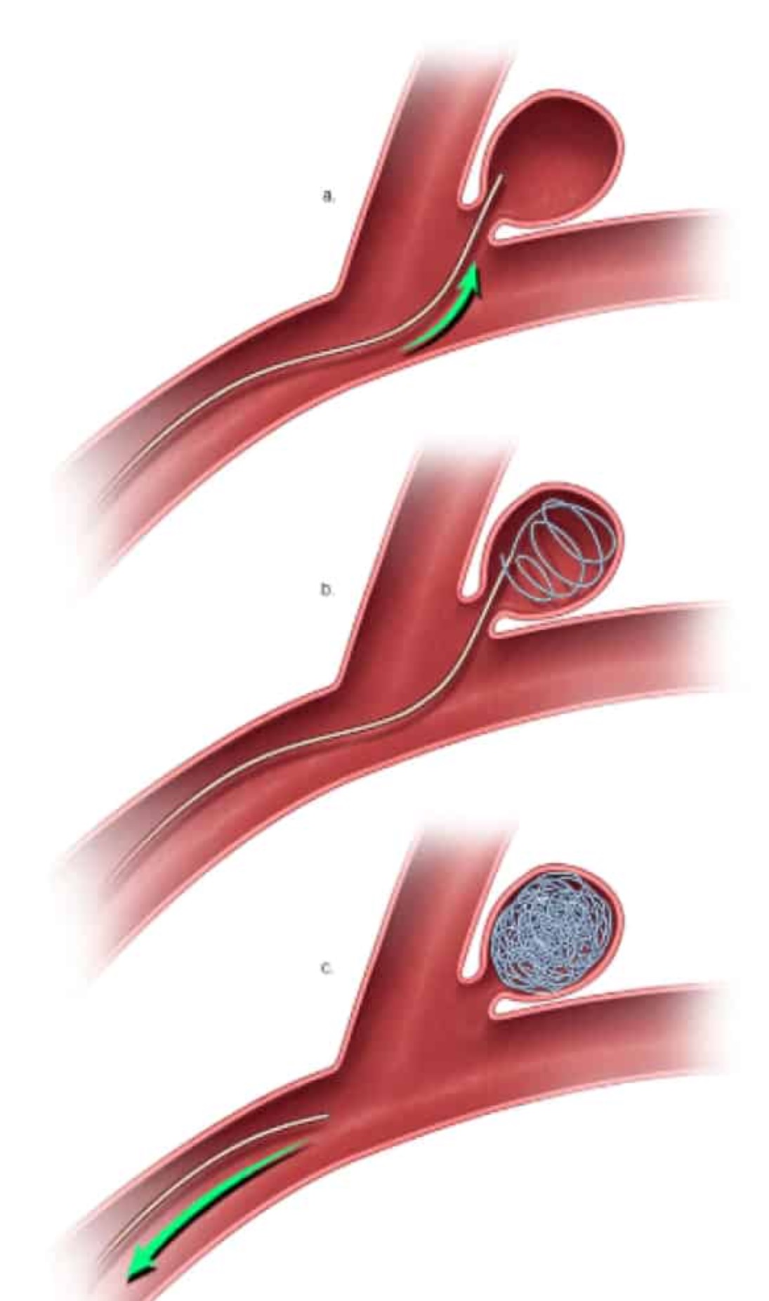 Three stages of endovascular coiling procedure