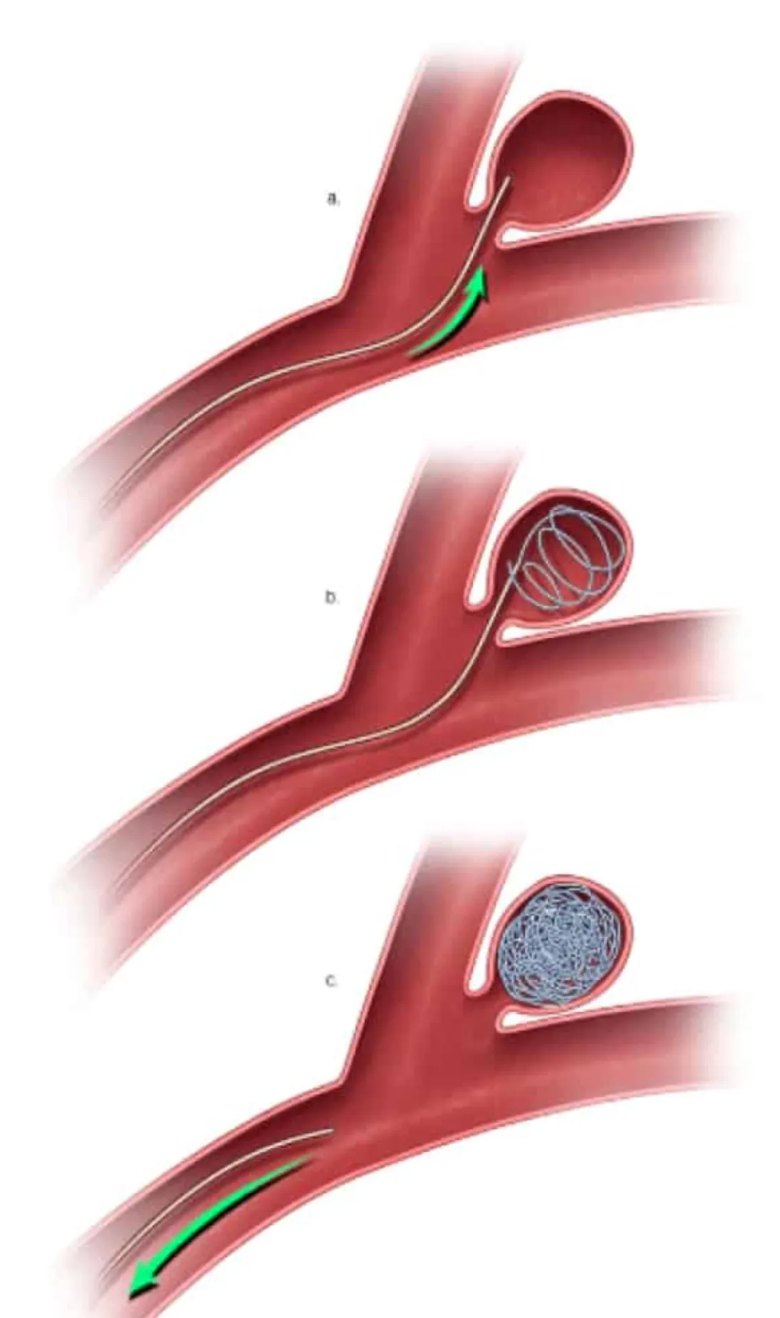 Three stages of endovascular coiling procedure