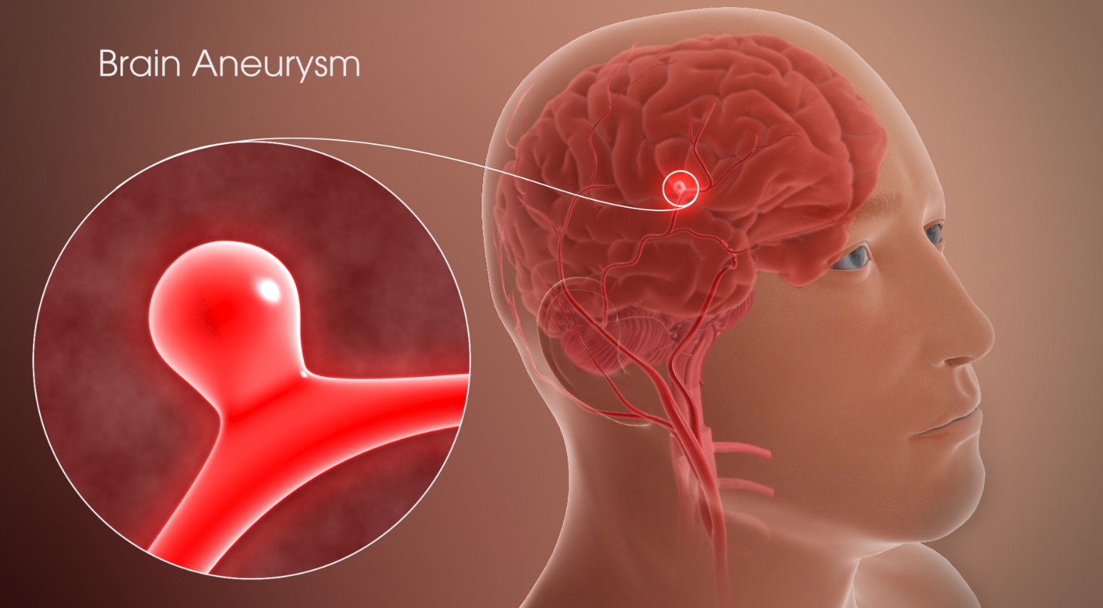 3D angiogram showing brain aneurysms in the Circle of Willis