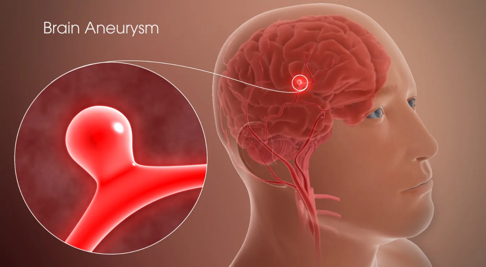 3D angiogram showing brain aneurysms in the Circle of Willis