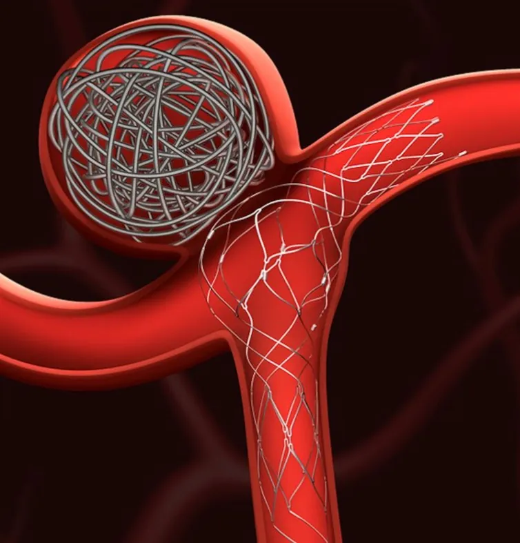 Stent-assisted coiling for brain aneurysm treatment