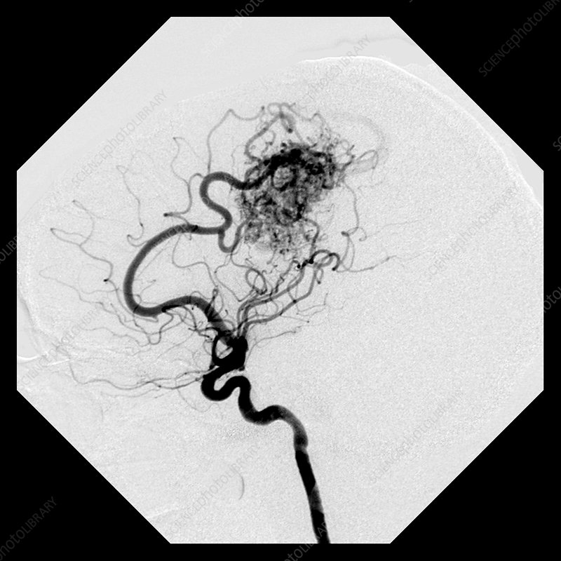 Lateral cerebral angiogram showing the typical appearance of a high-flow arteriovenous malformation