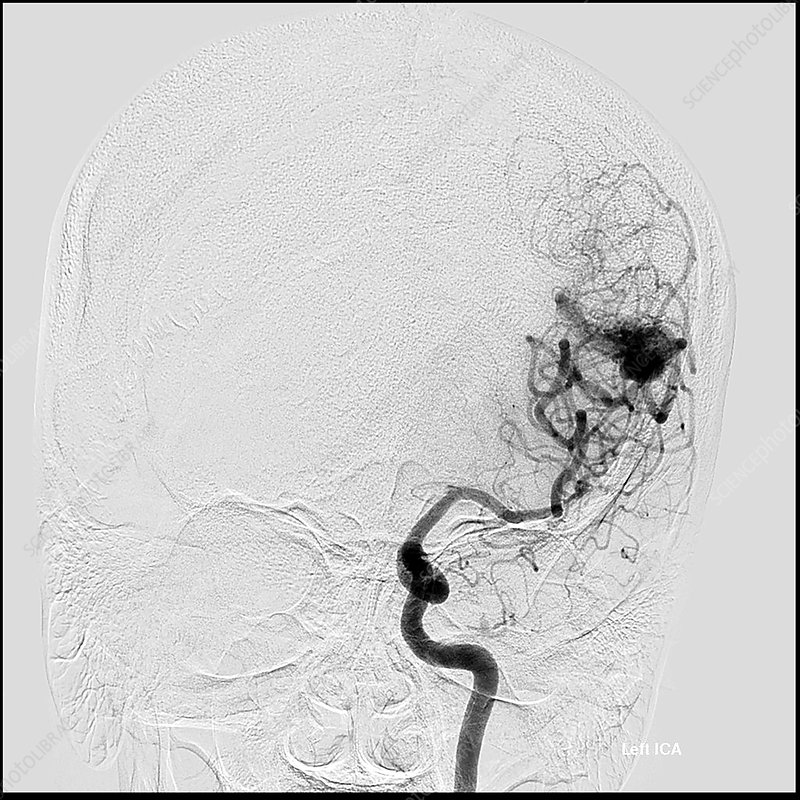 Frontal cerebral angiogram from a left internal carotid artery injection showing a high-flow AVM in the left temporal lobe