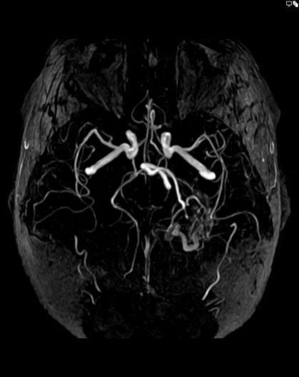 Time-of-flight MRA showing a brain AVM, rotated projection view