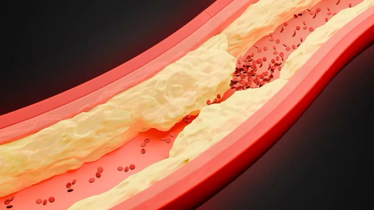 Warning signs of carotid artery disease