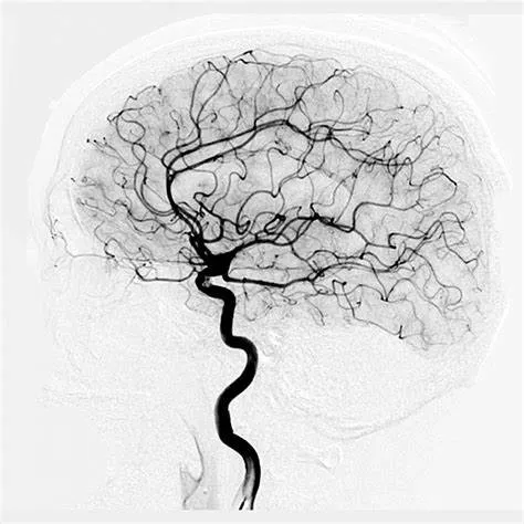 Benefits of cerebral angiography
