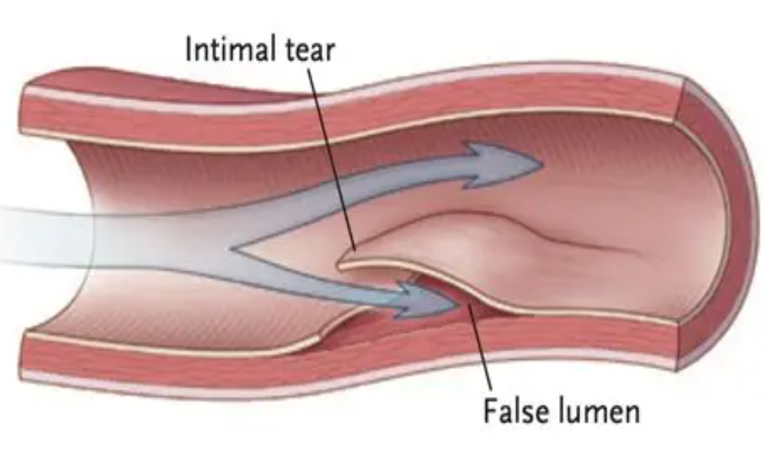 Carotid and vertebral artery dissection