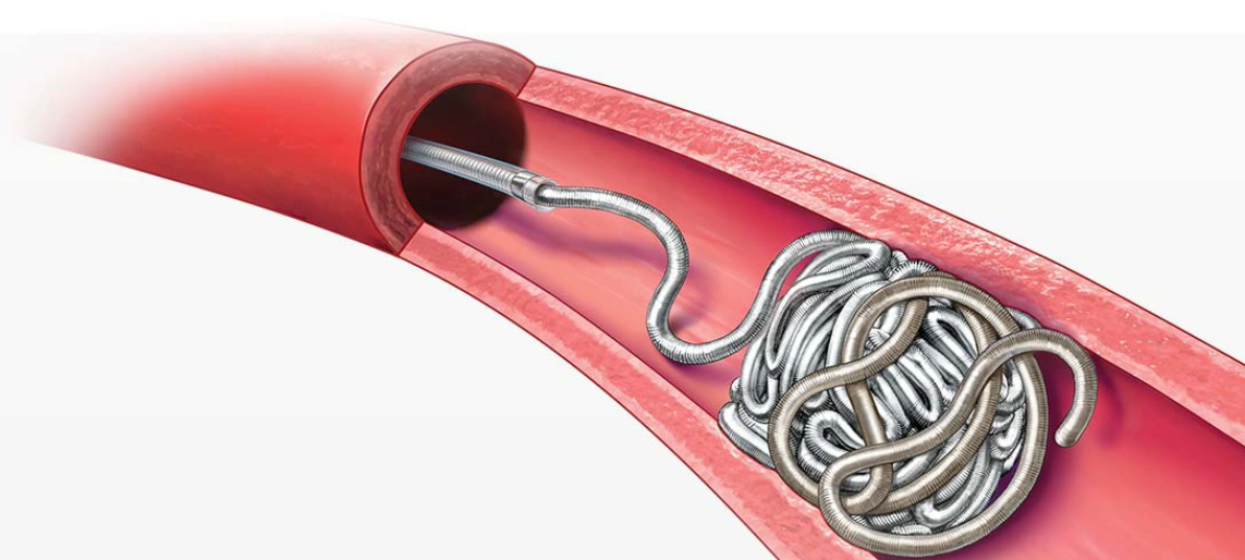 Benefits of epistaxis embolization