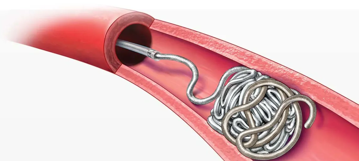 Benefits of epistaxis embolization