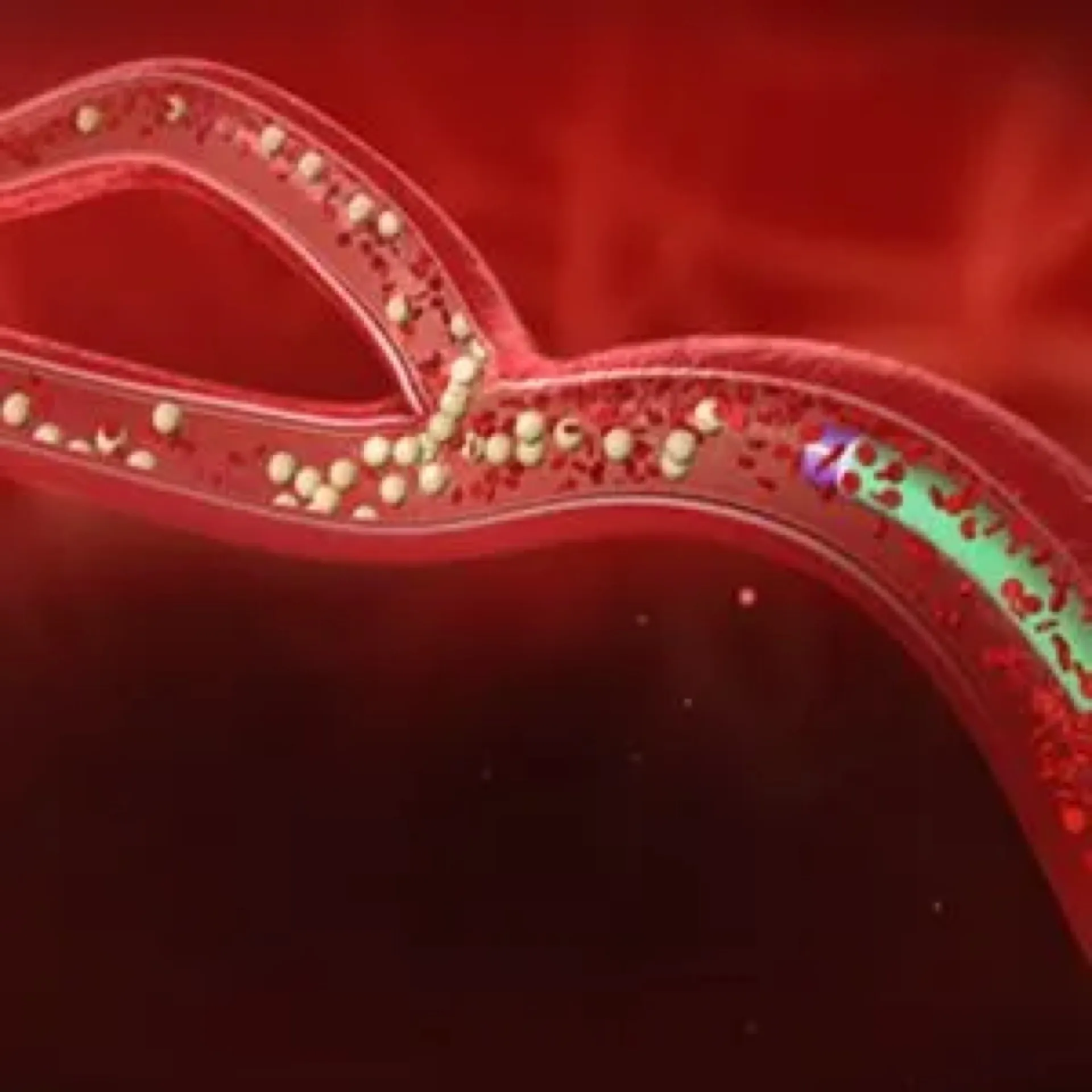 Particle Embolization