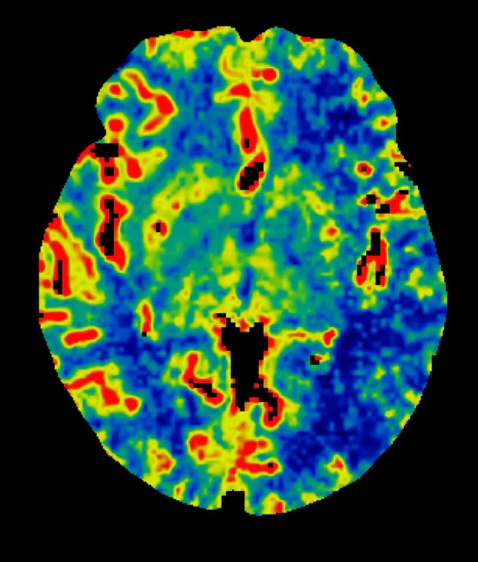 Understanding stroke — illustration of brain blood flow