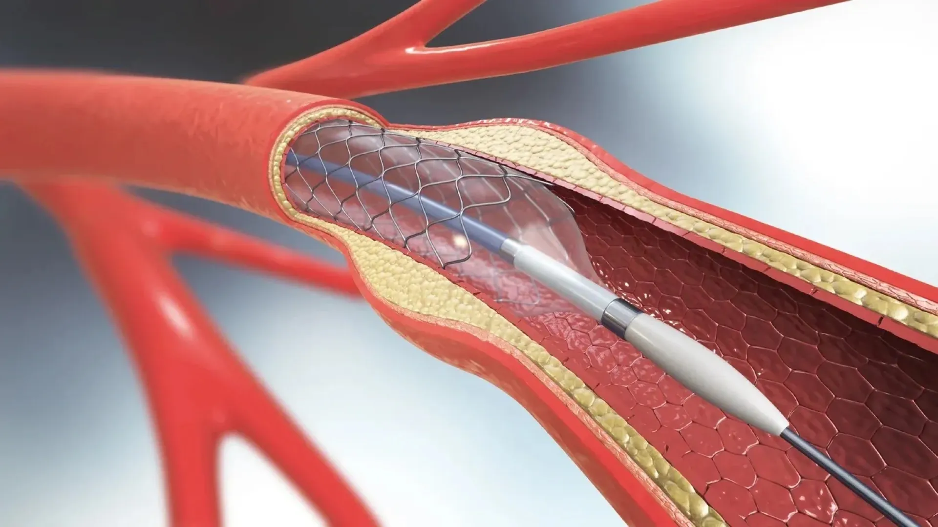 Carotid artery imaging and diagnostic evaluation
