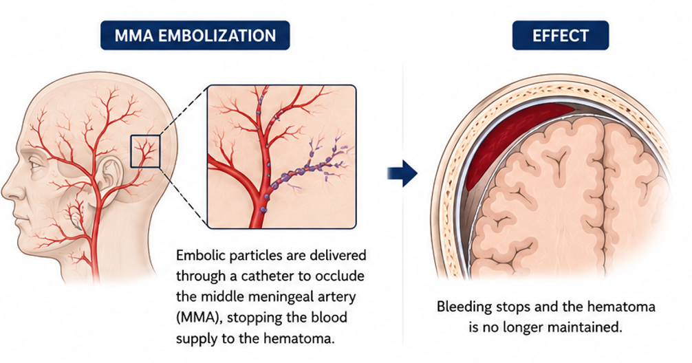 The embolization procedure