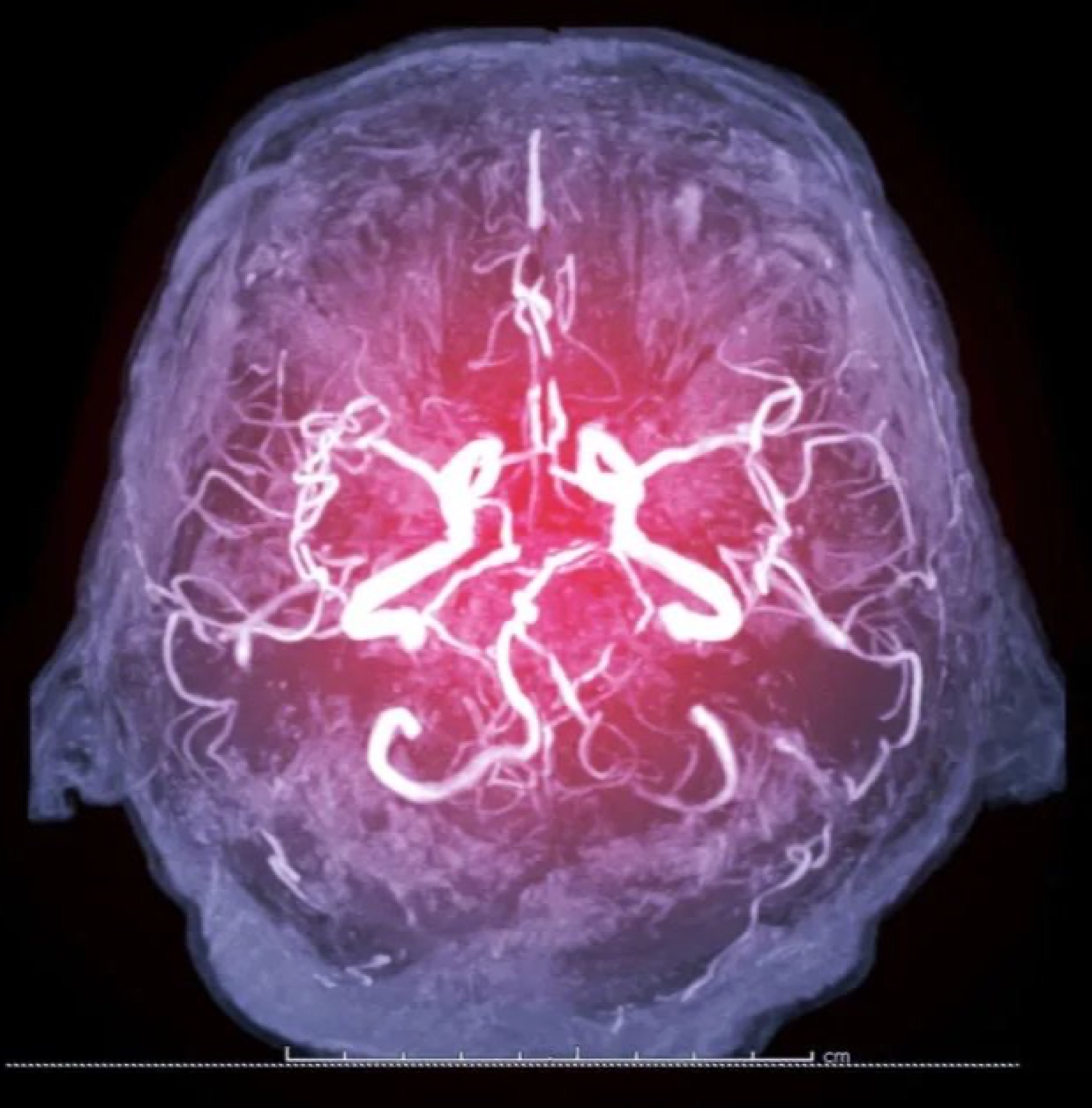 Subdural hematoma treatment comparison