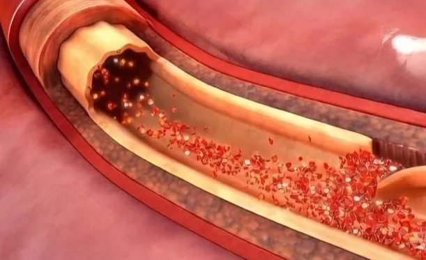 Vascular Dissection